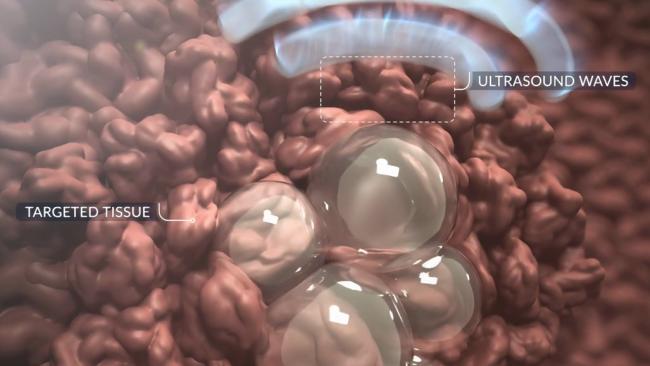 illustration shows microbubbles formed by histotripsy destroying cancer cells in the liver