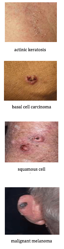 Four skin cancer types, ranging from keratosis to melanoma.