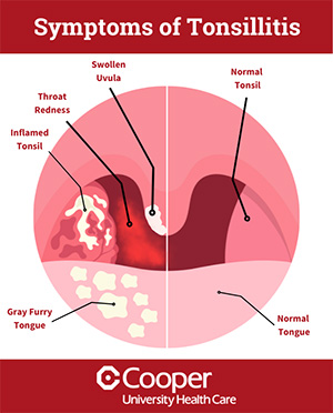 tonsillitis-image