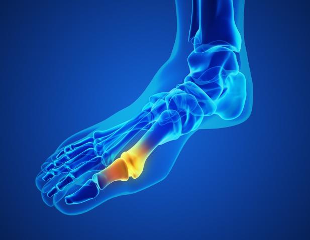 Foot Animation Gout Toe Joint