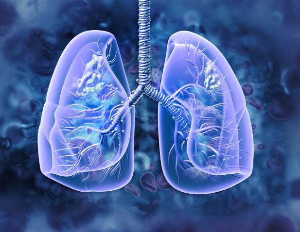 Illustration of lungs with lung cancer
